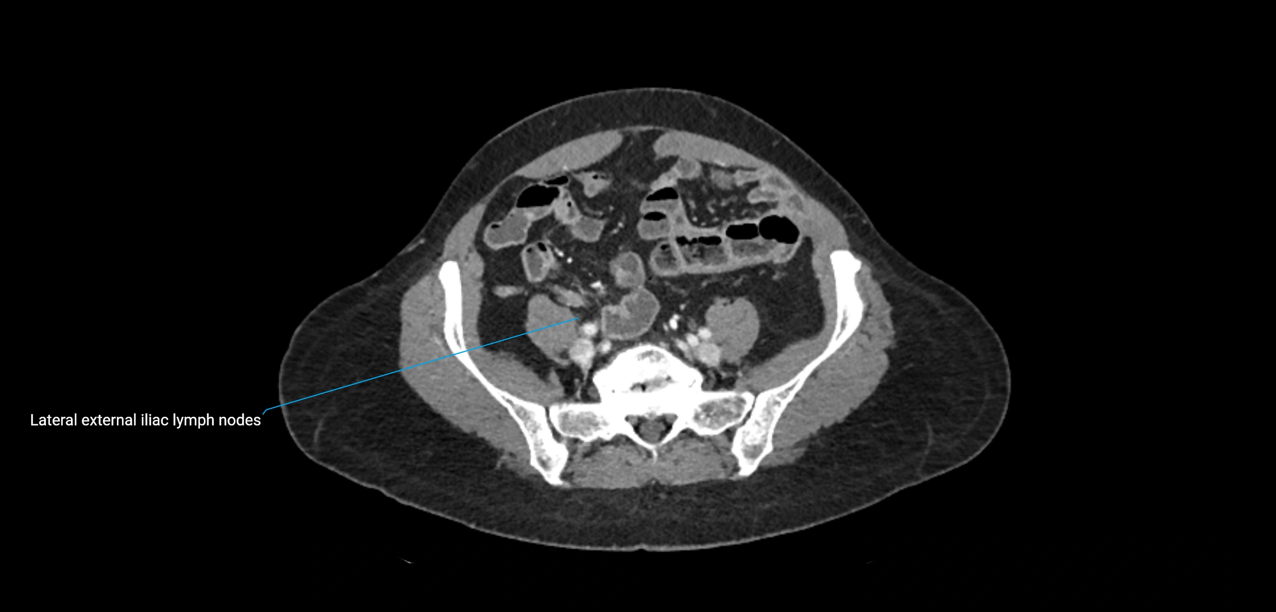 CT ct abdominal lymph nodes  axial cross sectional anatomy  enchanced radiology image -img-00002-00313.webp